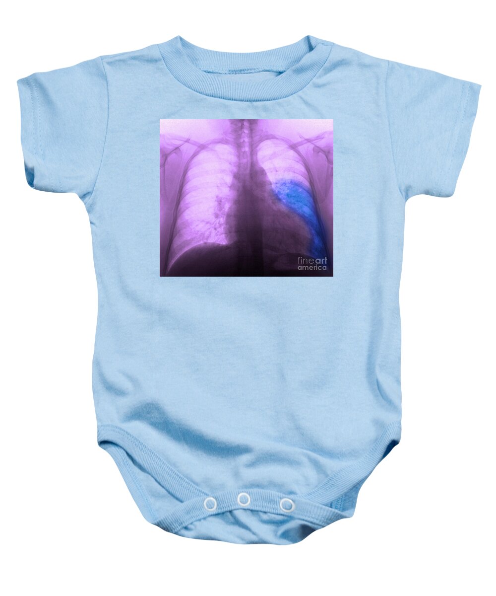 X Ray Baby Onesie featuring the photograph Pneumonia, X Ray by Scott Camazine