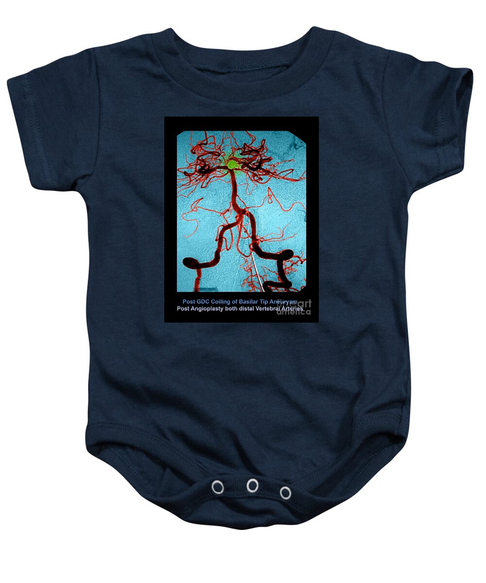 Abnormal Blood Vessel Baby Onesie featuring the photograph Cerebral Angiogram #2 by Medical Body Scans