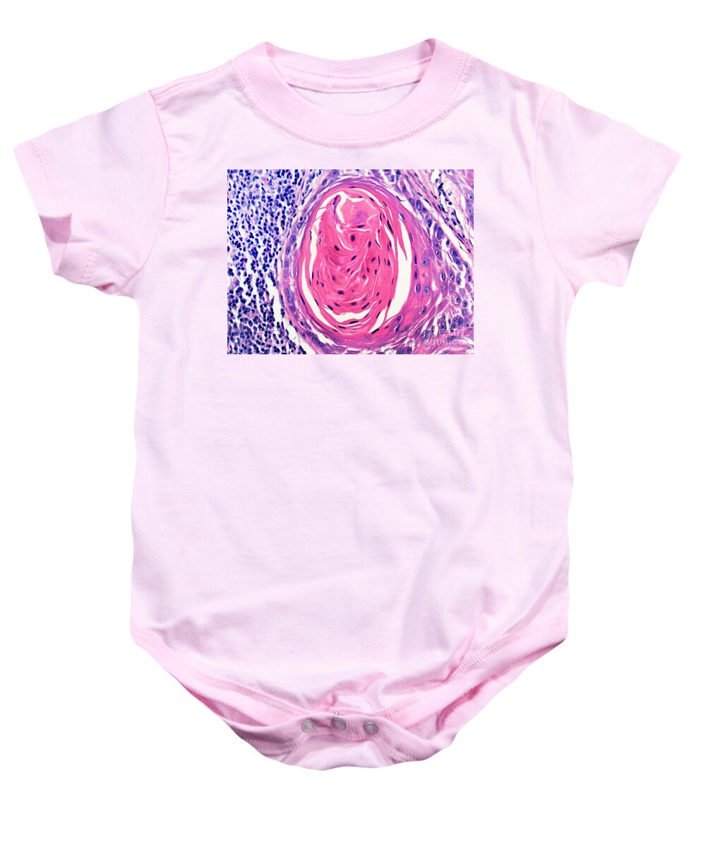 Light Micrograph Baby Onesie featuring the photograph Squamous Cell Carcinoma, Keratin Pearl #2 by Garry DeLong
