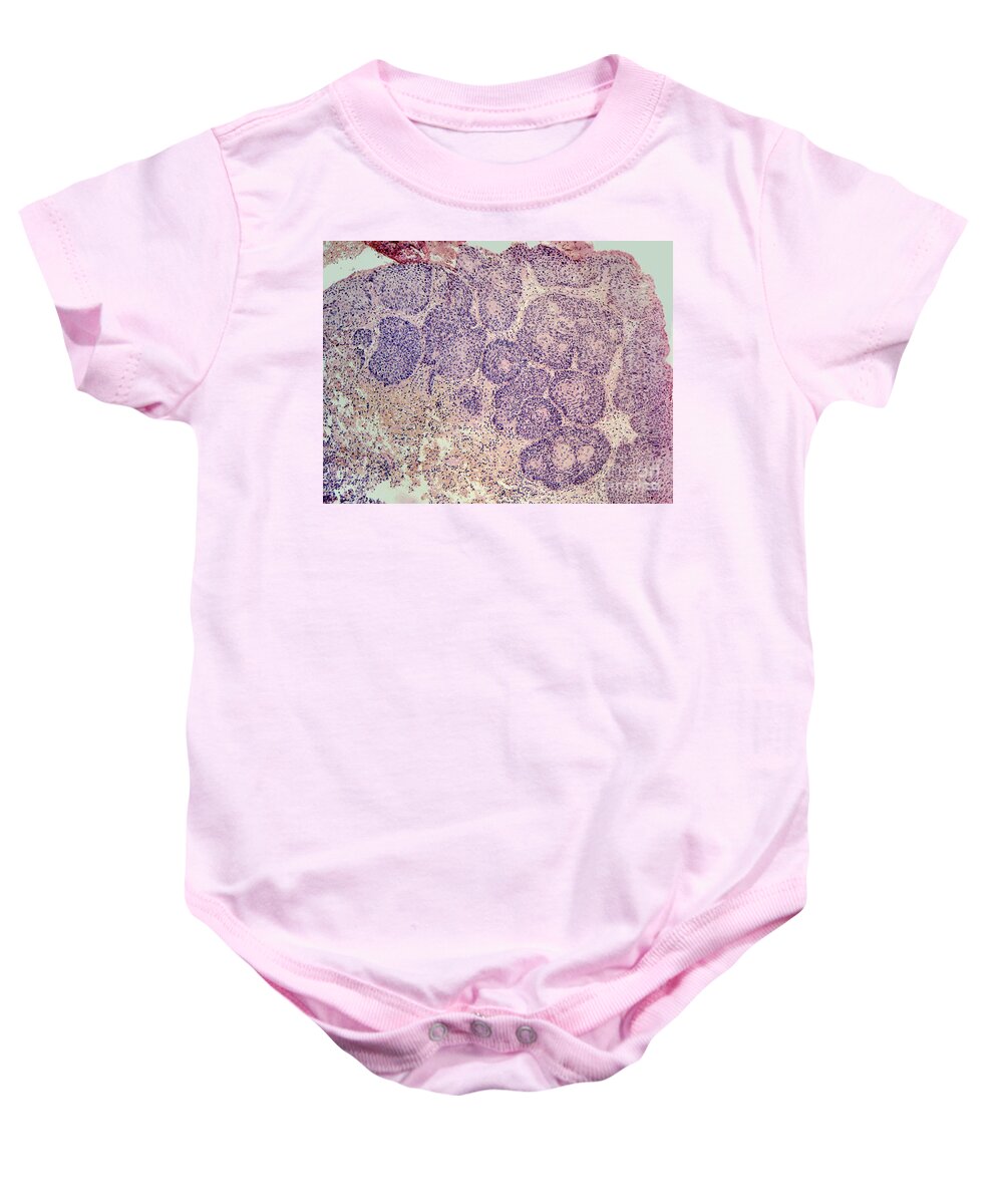 Light Micrograph Baby Onesie featuring the photograph Lm Of Squamous Cell Carcinoma Pearls by Garry DeLong