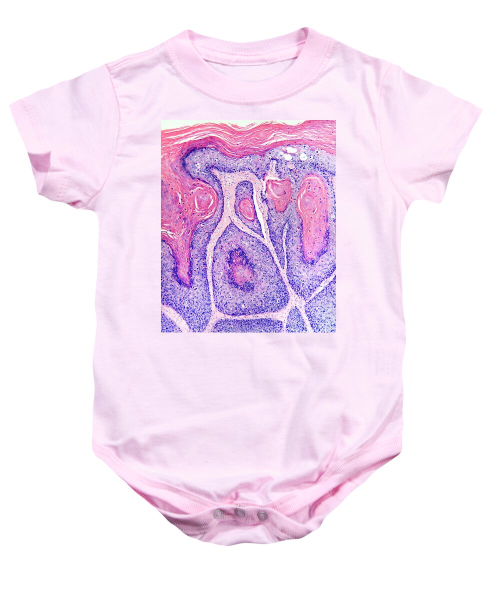 Squamous In Situ Baby Onesie featuring the photograph Skin Cancer, Bowens Disease, Lm by Garry DeLong