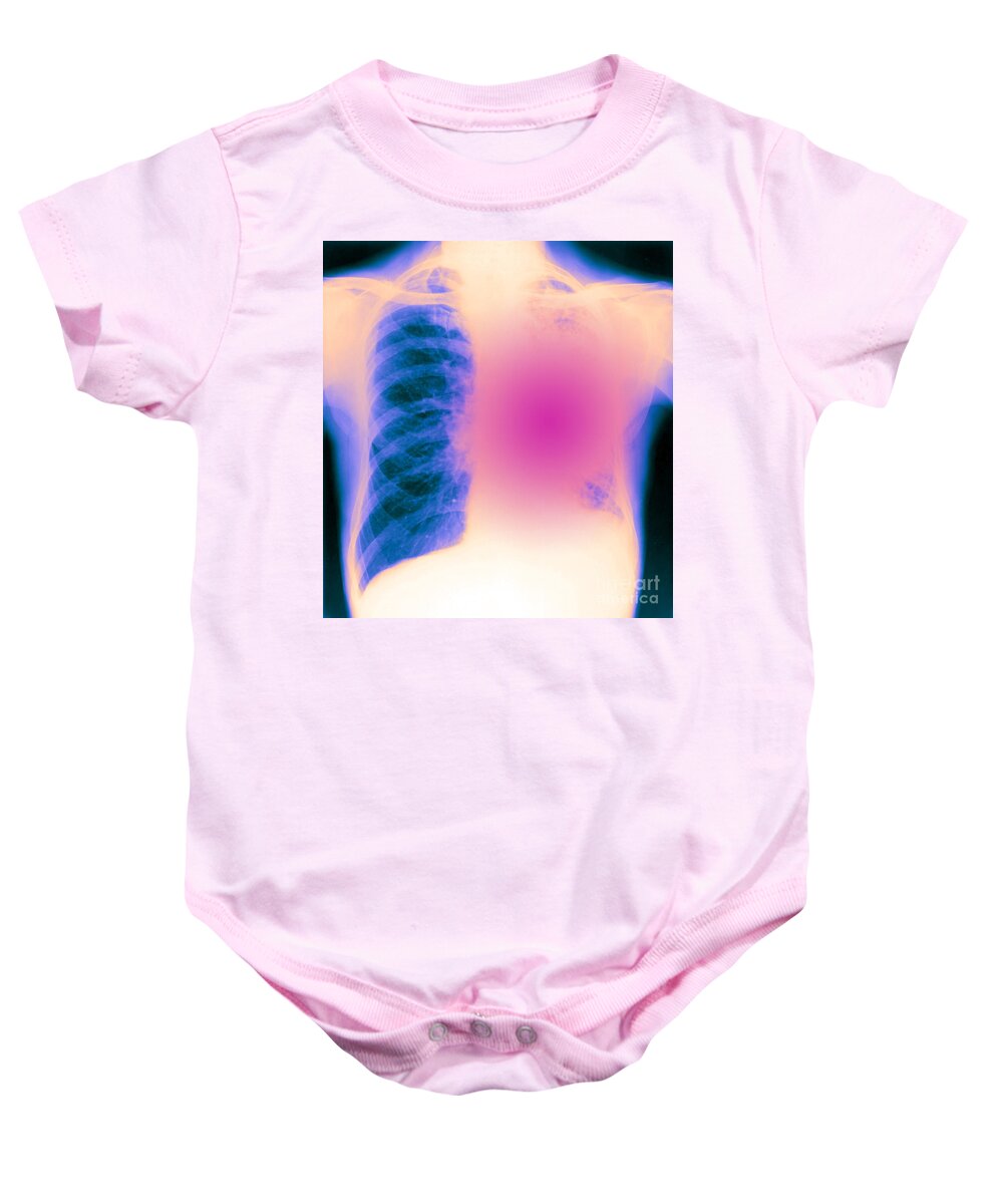 X-ray Baby Onesie featuring the photograph X-ray Of Bronchial Carcinoma #1 by Biophoto Associates