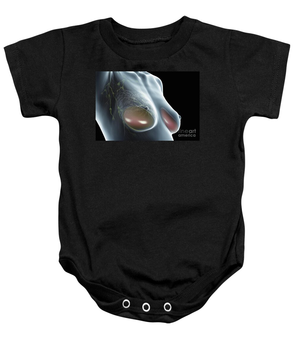 Transparent Baby Onesie featuring the photograph Breast Implants by Science Picture Co