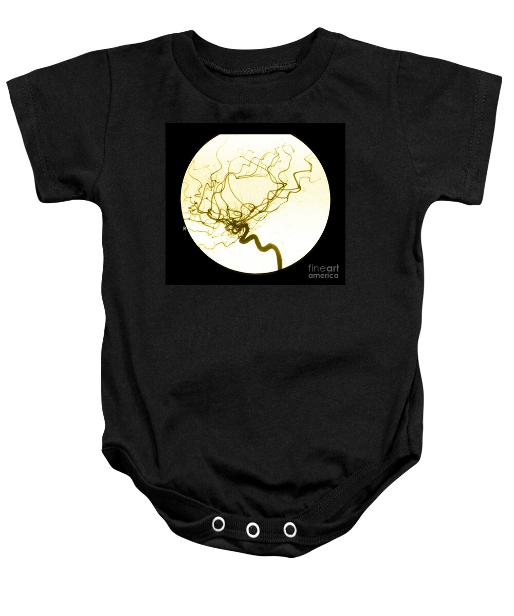 Cerebral Angiogram Baby Onesie featuring the photograph Internal Carotid Cerebral Angiogram by Medical Body Scans