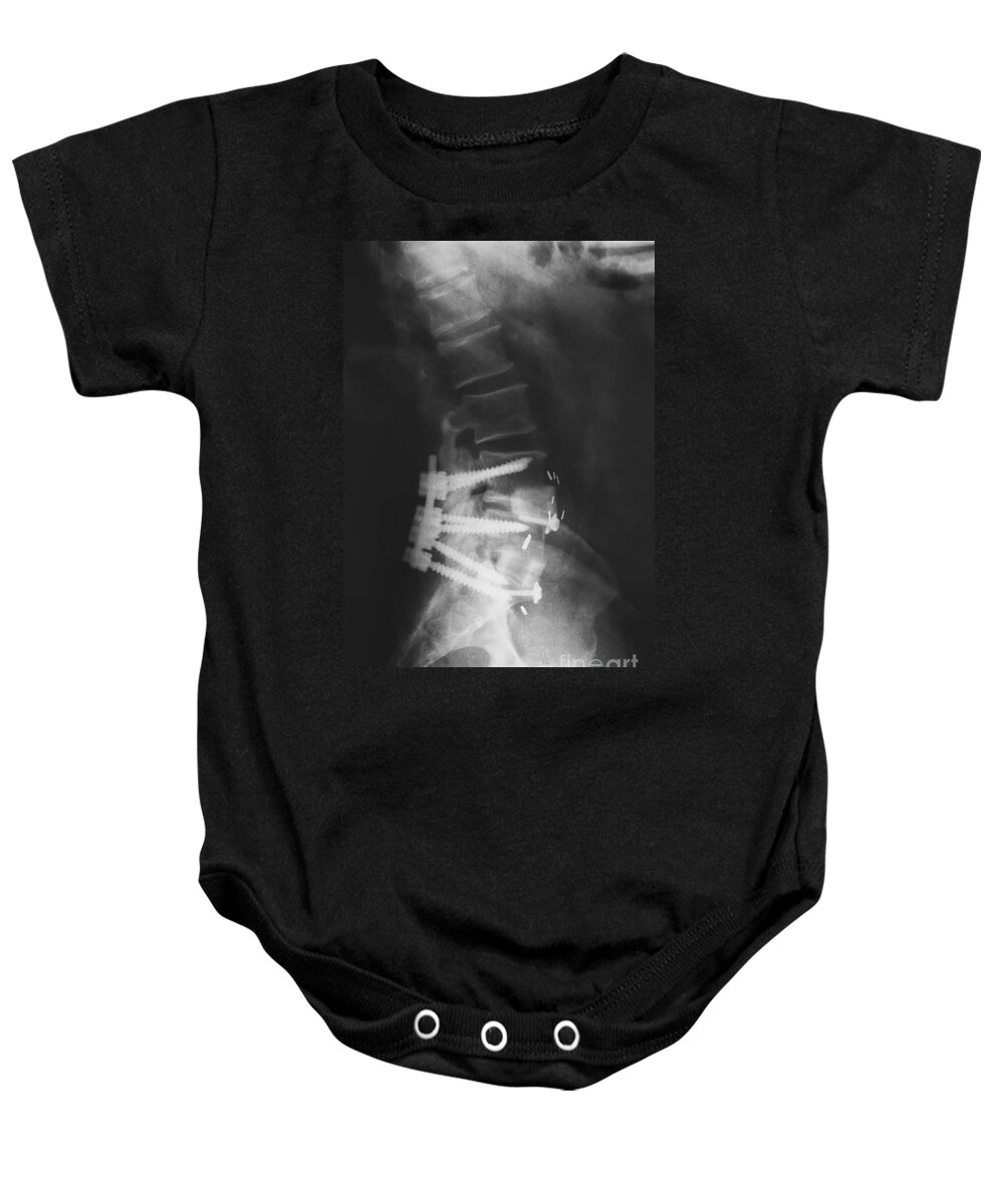 Lumbar Spinal Fusion Baby Onesie featuring the photograph Lumbar Spinal Fusion by Olga Hamilton