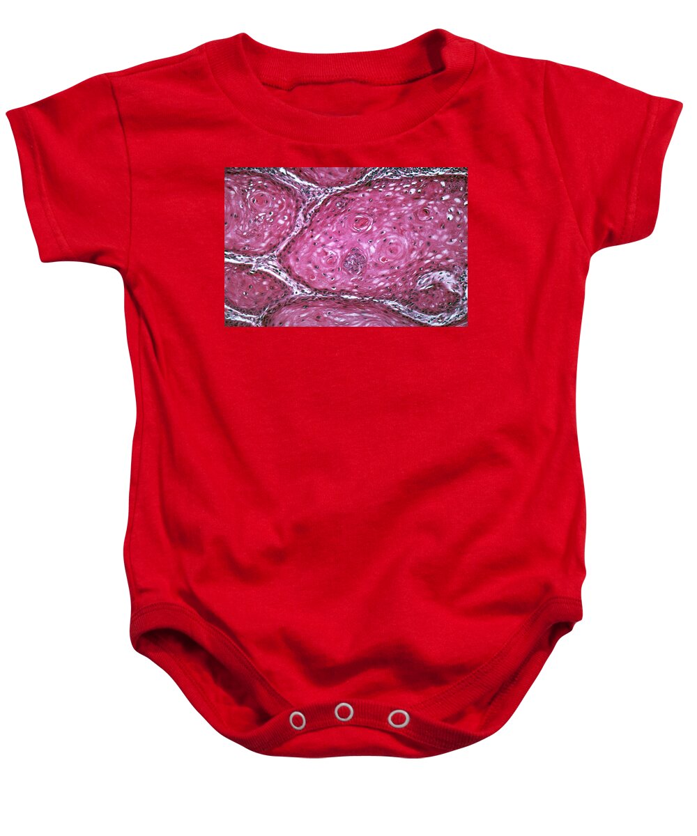 Anatomy Baby Onesie featuring the photograph Squamous Cell Carcinoma, Lm #2 by Michael Abbey