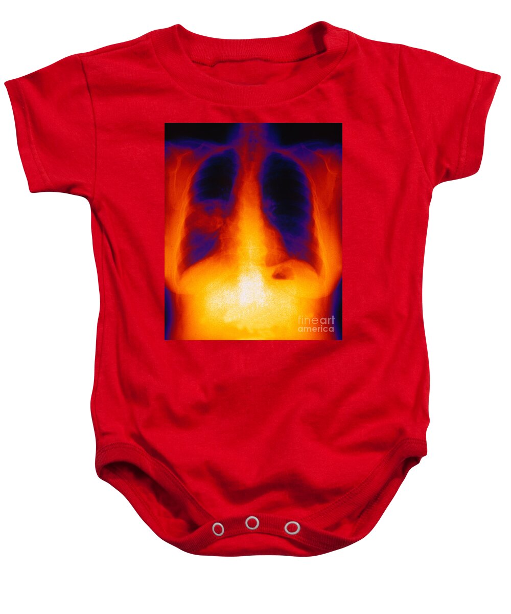 Medical Baby Onesie featuring the photograph Squamous Cell Carcinoma, Lungs, X-ray by Scott Camazine