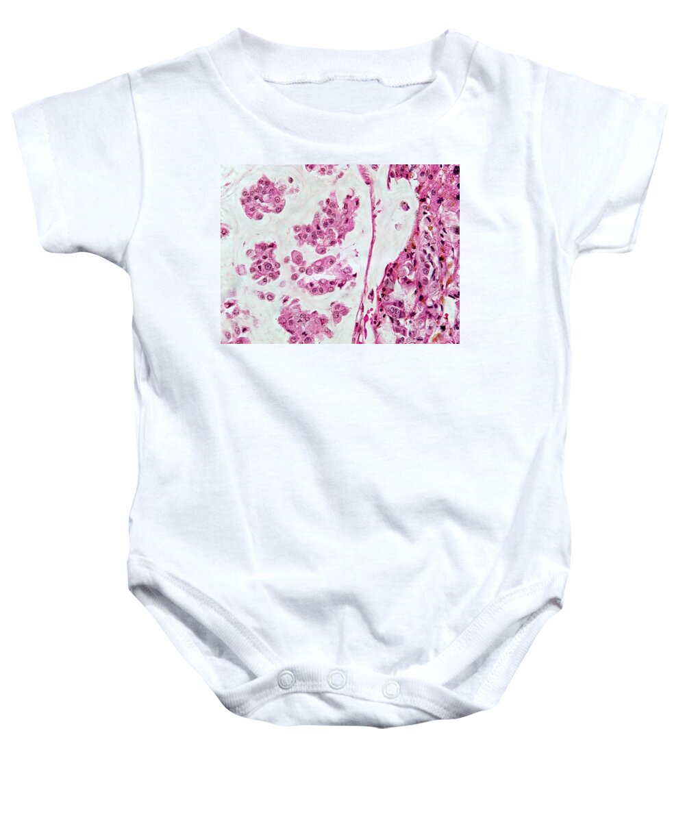 Micrograph Baby Onesie featuring the photograph Colloid Liver Tumor, Lm #2 by Garry DeLong