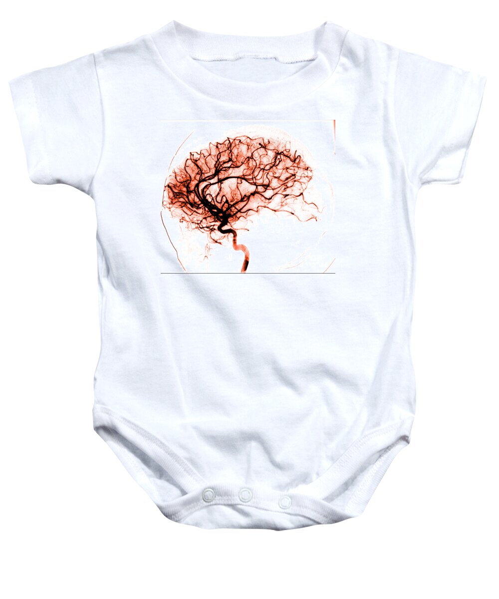 Catheter Cerebral Angiogram Baby Onesie featuring the photograph Cerebral Angiogram by Medical Body Scans