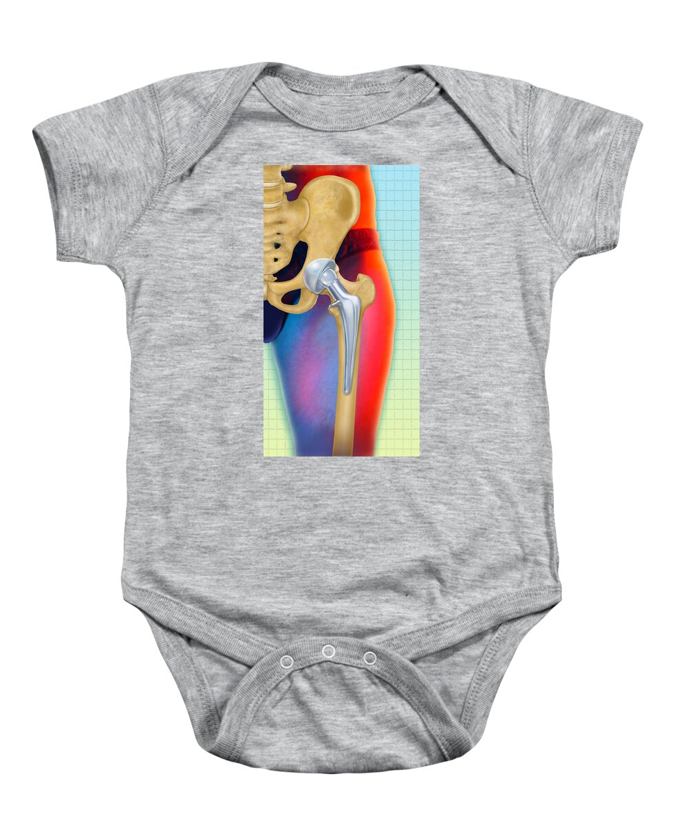 Art Baby Onesie featuring the photograph Prosthetic Hip Replacement by Chris Bjornberg