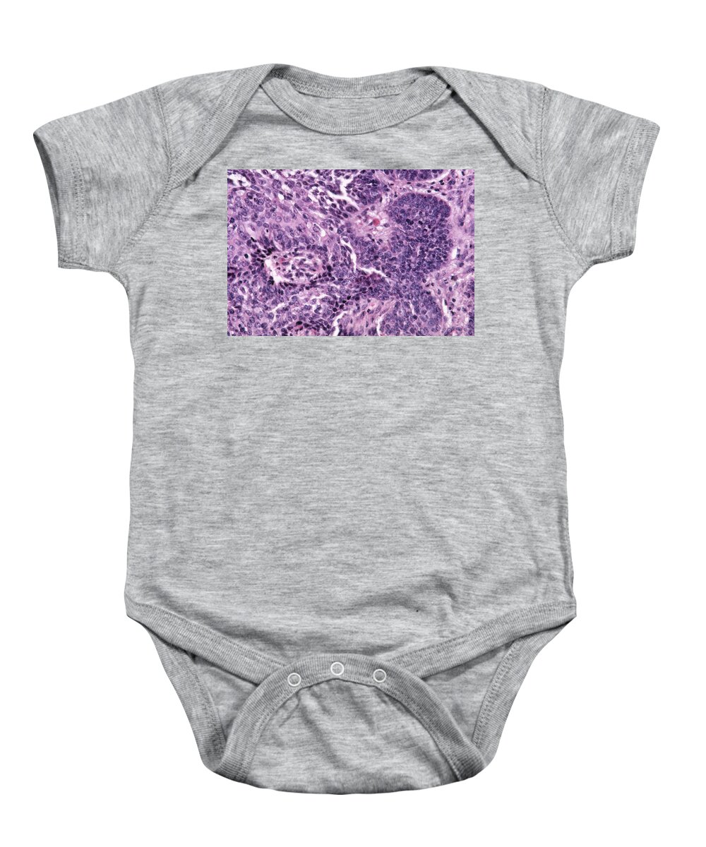 Anatomy Baby Onesie featuring the photograph Basal-cell Carcinoma, Lm by Michael Abbey
