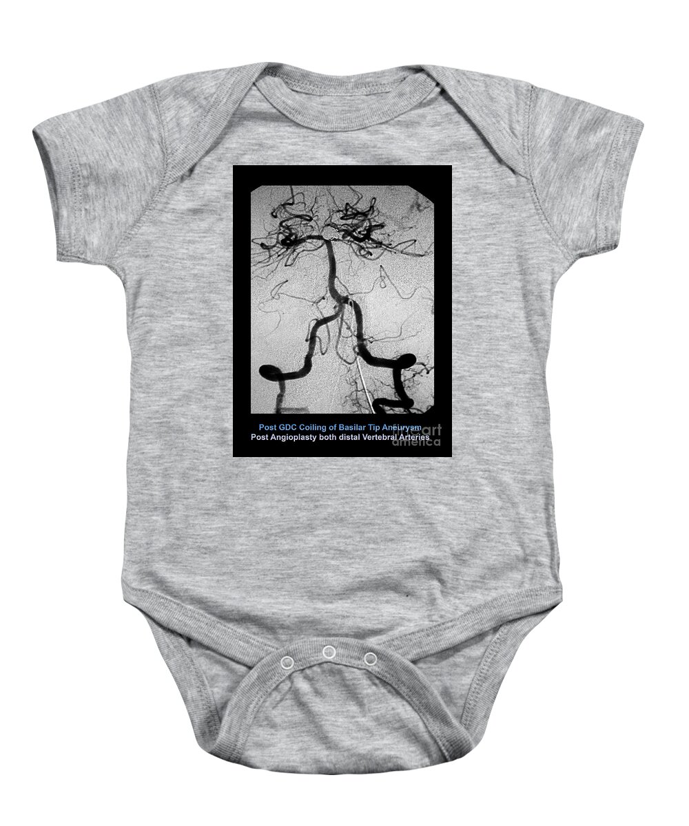 Cerebral Baby Onesie featuring the photograph Cerebral Angiogram by Medical Body Scans
