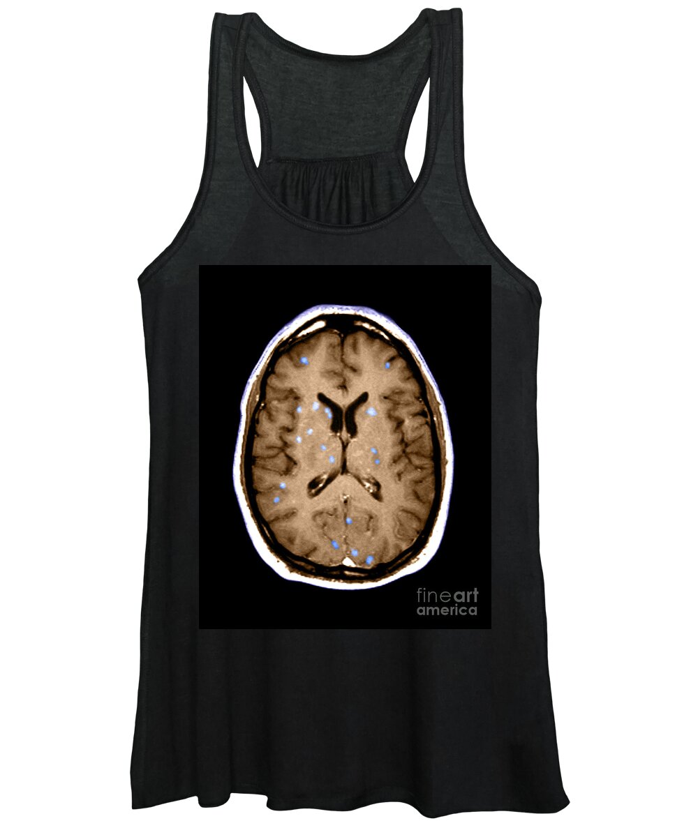 Medical Image Women's Tank Top featuring the photograph Abnormal Mri Of Brain #2 by Medical Body Scans