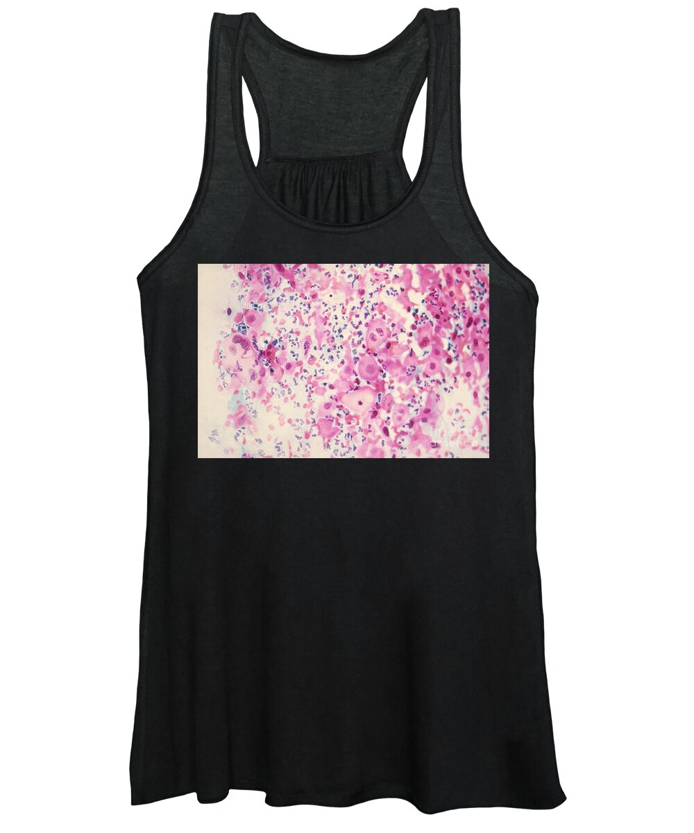 Medical Women's Tank Top featuring the photograph Pap Smear Cancer #3 by Science Source