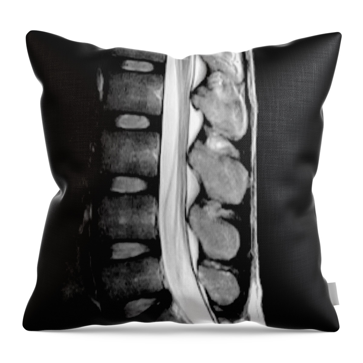 Degenerative Disc Disease Throw Pillow by Living Art Enterprises - Pixels