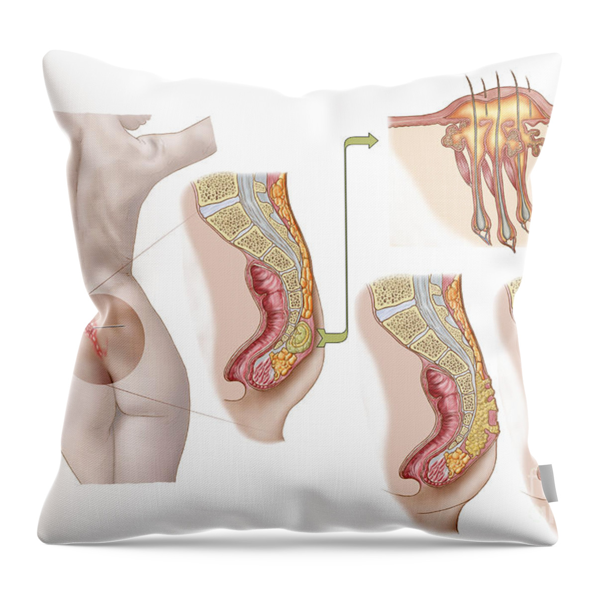 https://render.fineartamerica.com/images/rendered/default/throw-pillow/images-medium-5/medical-ilustration-of-a-pilonidal-cyst-stocktrek-images.jpg?&targetx=-111&targety=0&imagewidth=702&imageheight=479&modelwidth=479&modelheight=479&backgroundcolor=FCFDFB&orientation=0&producttype=throwpillow-14-14