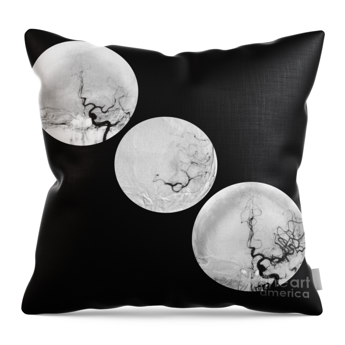 Angiogram Of Stroke Throw Pillow featuring the photograph Stroke Treatment by Medical Body Scans