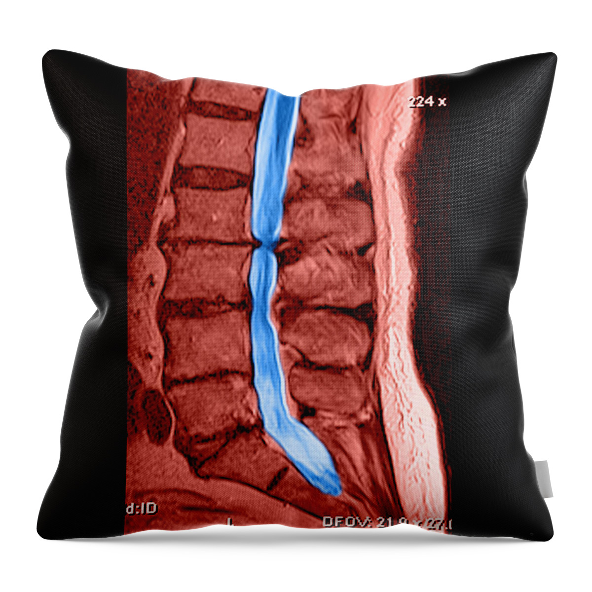 Severe Spinal Stenosis #3 Throw Pillow by Medical Body Scans - Fine Art  America