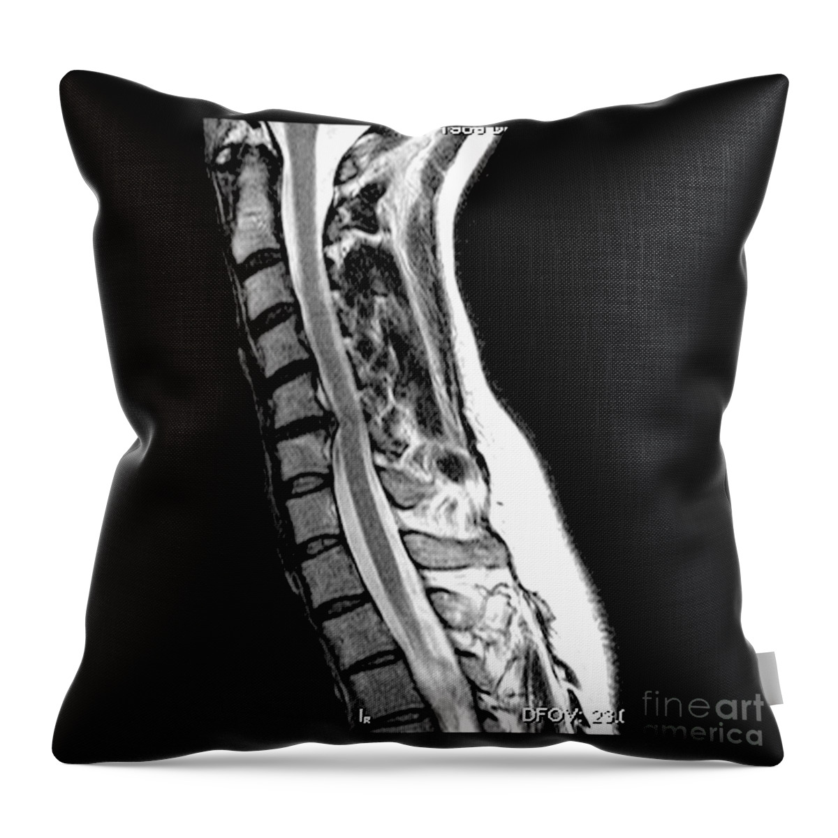 Herniated Disc In Cervical Spine Throw Pillow by Medical Body Scans - Fine  Art America