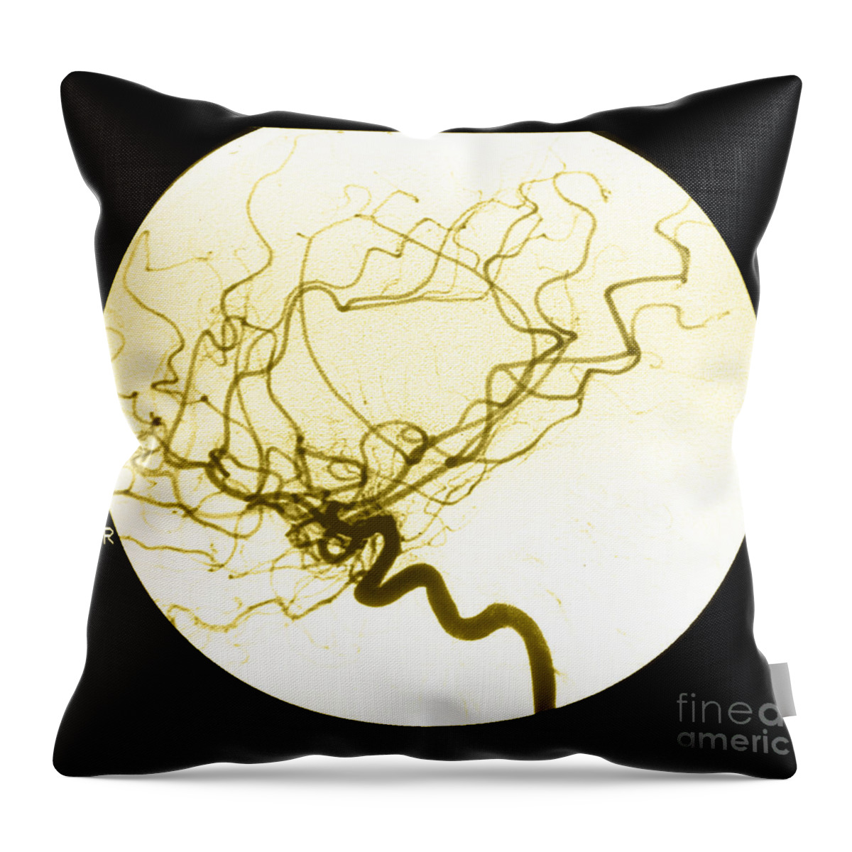 Cerebral Angiogram Throw Pillow featuring the photograph Internal Carotid Cerebral Angiogram by Medical Body Scans