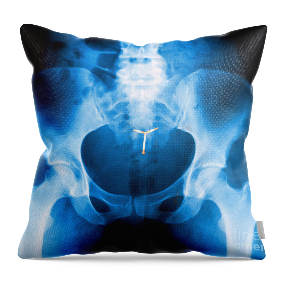 Birth Control Throw Pillow featuring the photograph Iud Contraceptive, X-ray by George Mattei