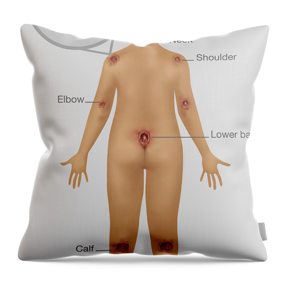 Woman With Pressure Sores, Illustration Throw Pillow by Gwen Shockey -  Pixels