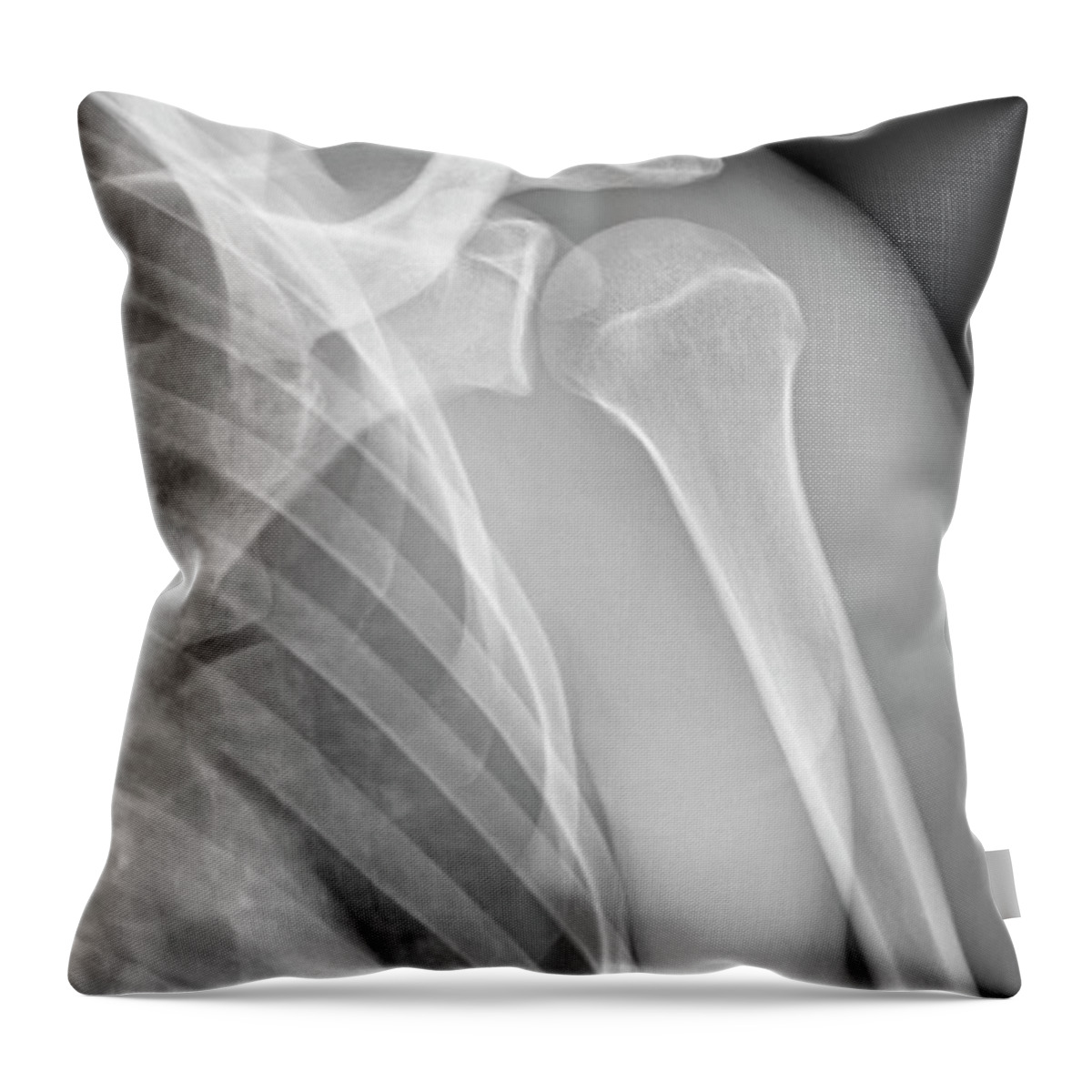 Hip Replacement #3 Throw Pillow by Medical Body Scans - Fine Art America
