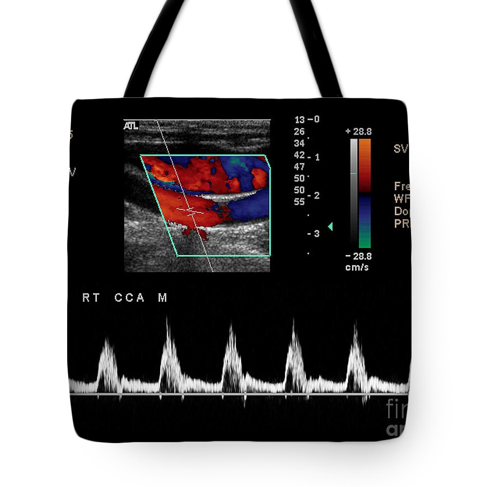 Carotid Artery Tote Bag featuring the photograph Carotid Duplex Ultrasound Exam #4 by Living Art Enterprises LLC