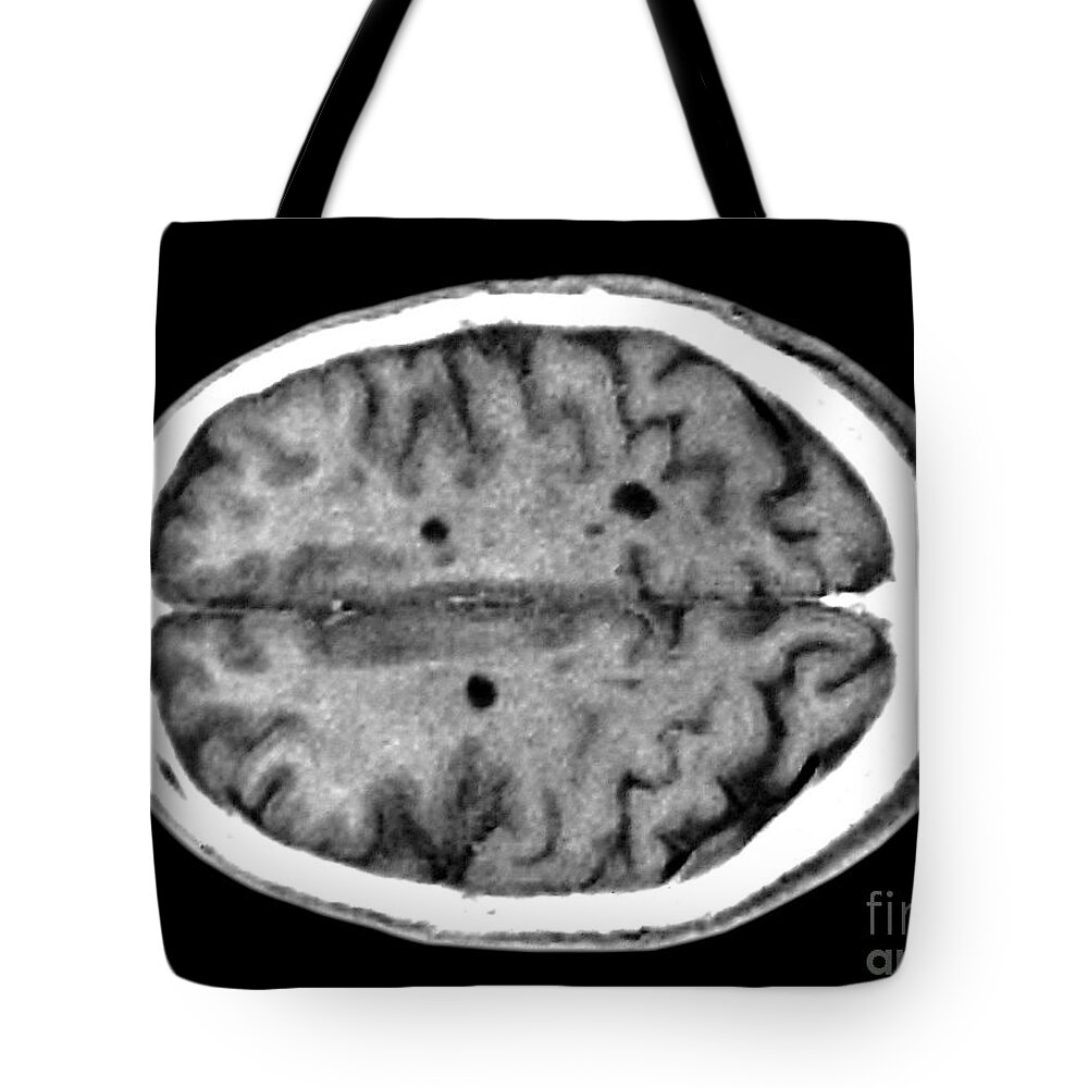 Radiology Tote Bag featuring the photograph Multiple Sclerosis Brain Lesions #1 by Scott Camazine