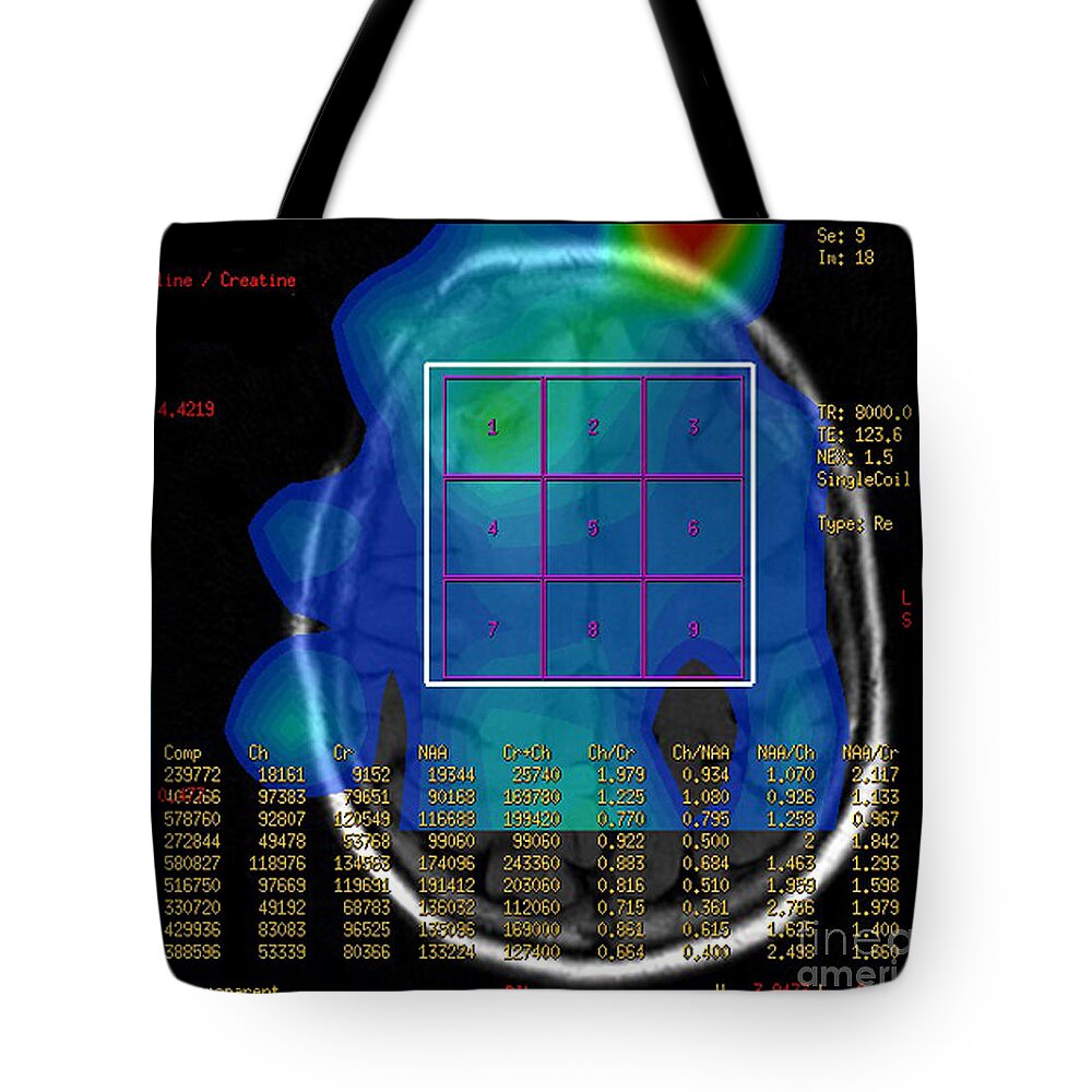 Mri Brain Tote Bag featuring the photograph Post Operative Mr Spectroscopy For Gbm #2 by Living Art Enterprises