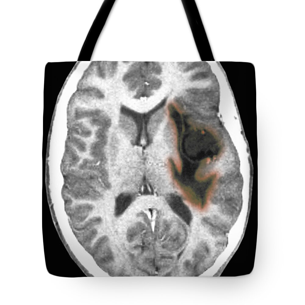 Radiology Tote Bag featuring the photograph Glioma Brain Tumor #3 by Scott Camazine