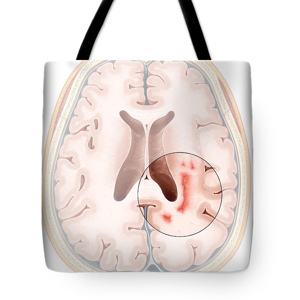 Science Tote Bag featuring the photograph Multiple Sclerosis #3 by Evan Oto