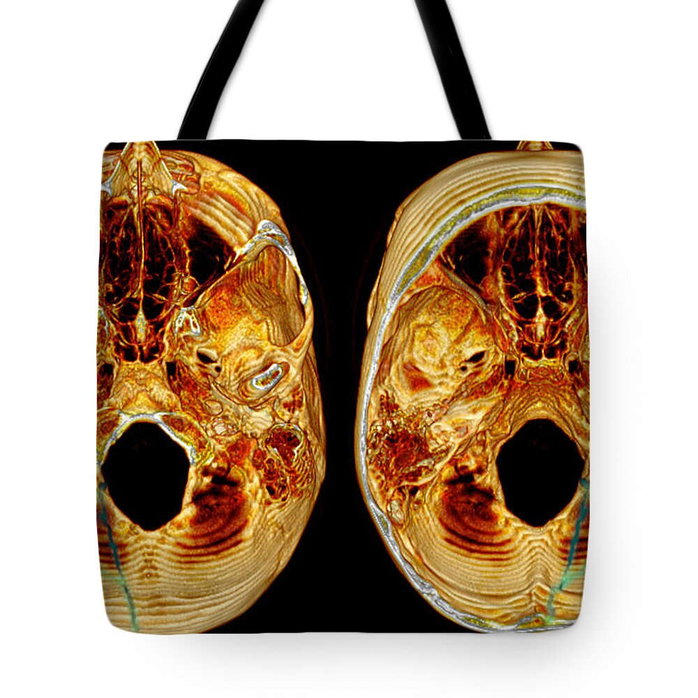 Fracture Tote Bag featuring the photograph 3d Ct Reconstruction Of Skull Fracture by Scott Camazine
