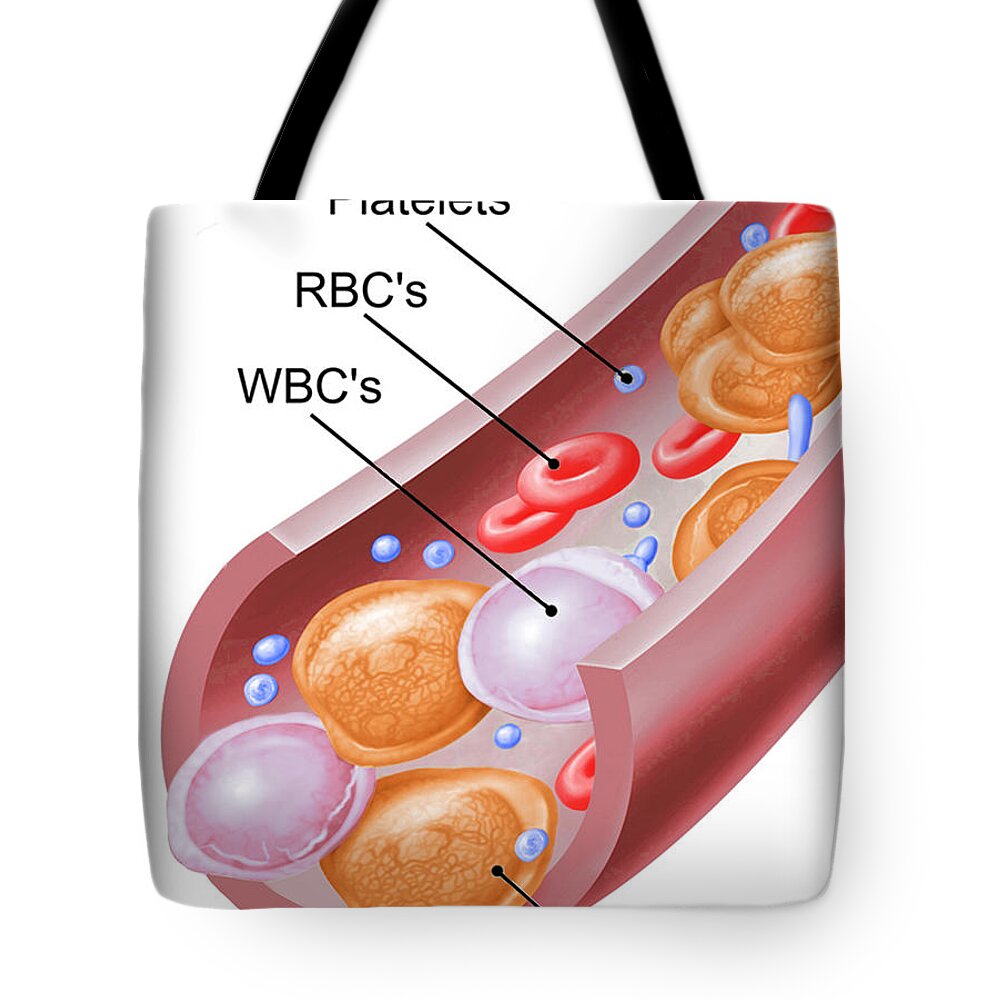 Science Tote Bag featuring the photograph Leukemia, Blood Cells, Illustration by Science Source