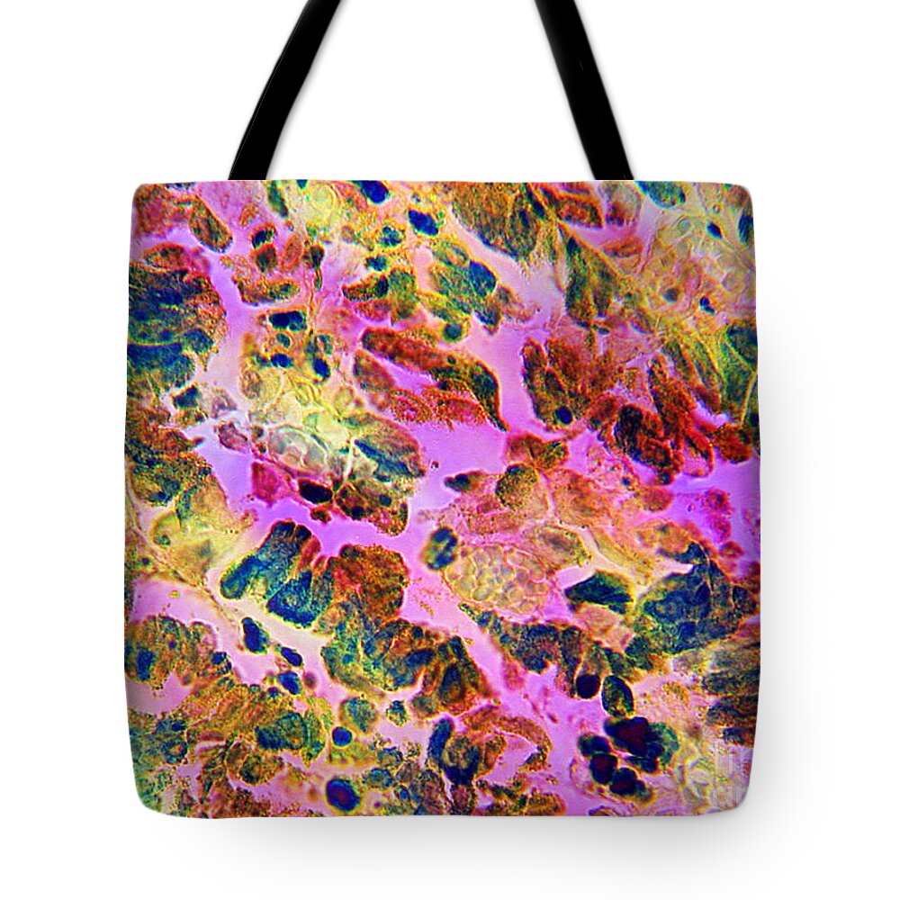 Malignant Melanoma Tote Bag featuring the photograph Malignant Melanoma by Dr Cecil H Fox