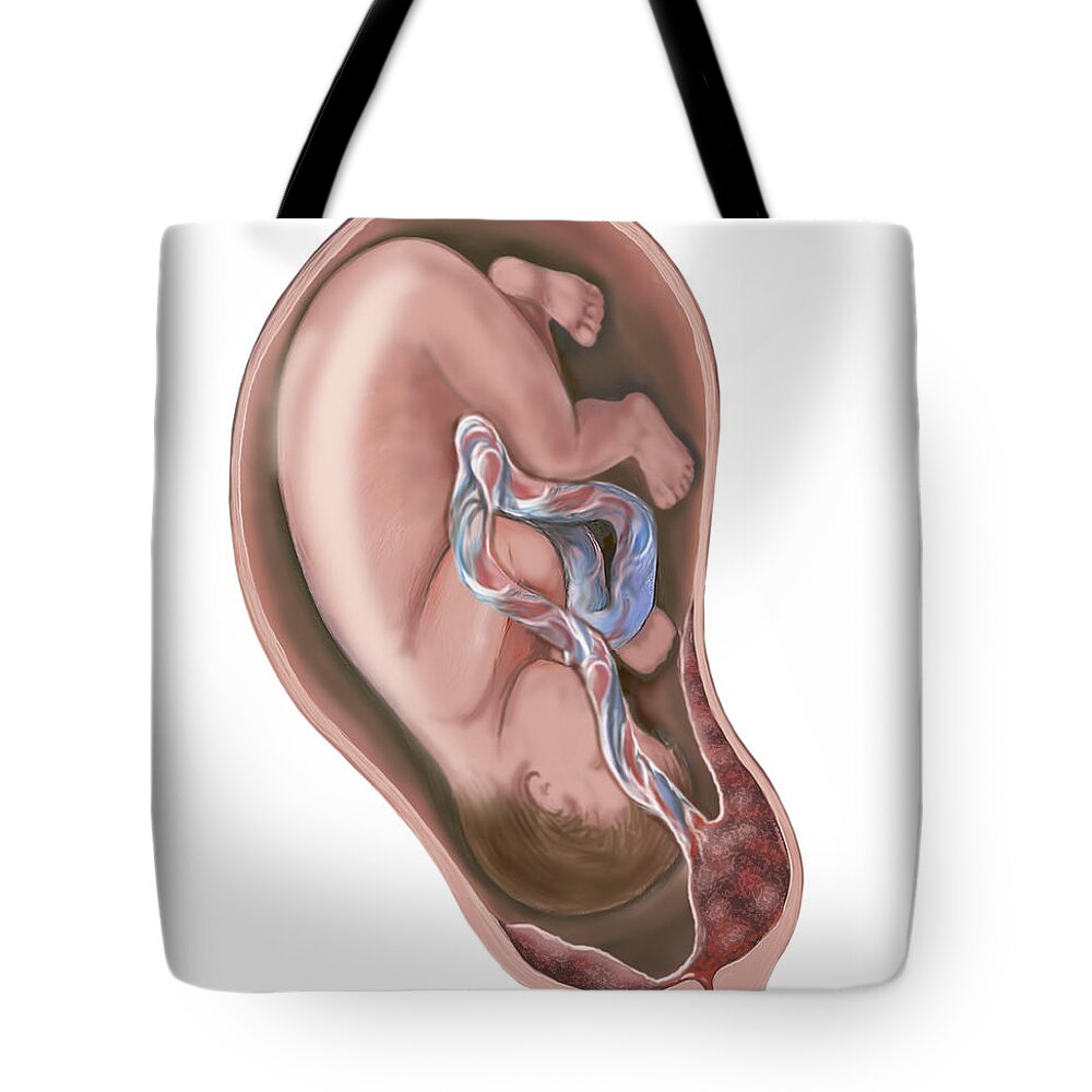 Placenta Previa Tote Bags