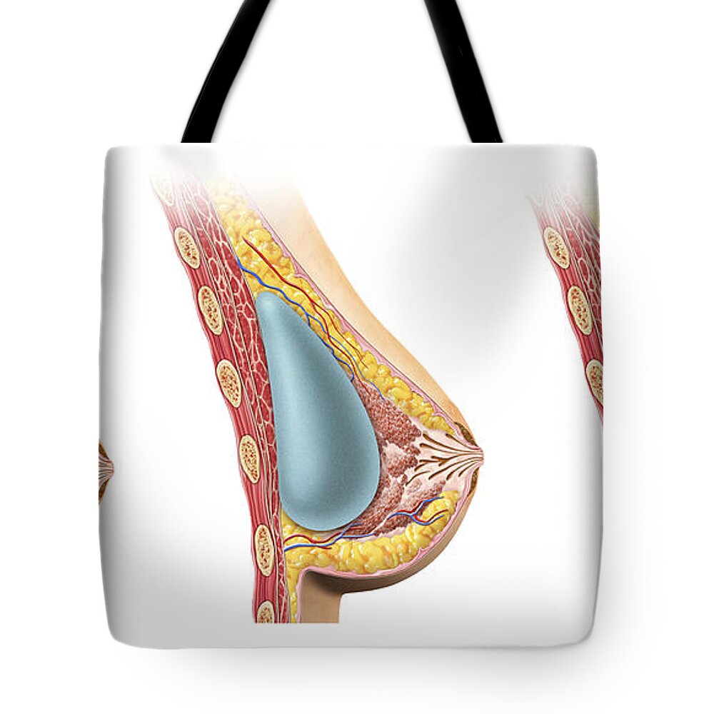 Woman Breast Implant Cross Section Tote Bag