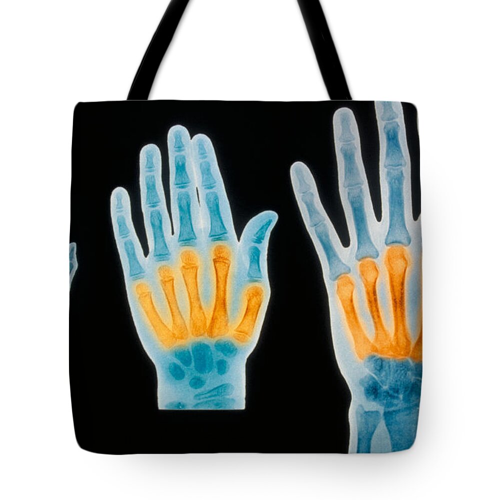 X-ray Of Hands Tote Bag featuring the photograph X-rays Of 2 Year Old, 7 Year Old by Scott Camazine & Sue Trainor