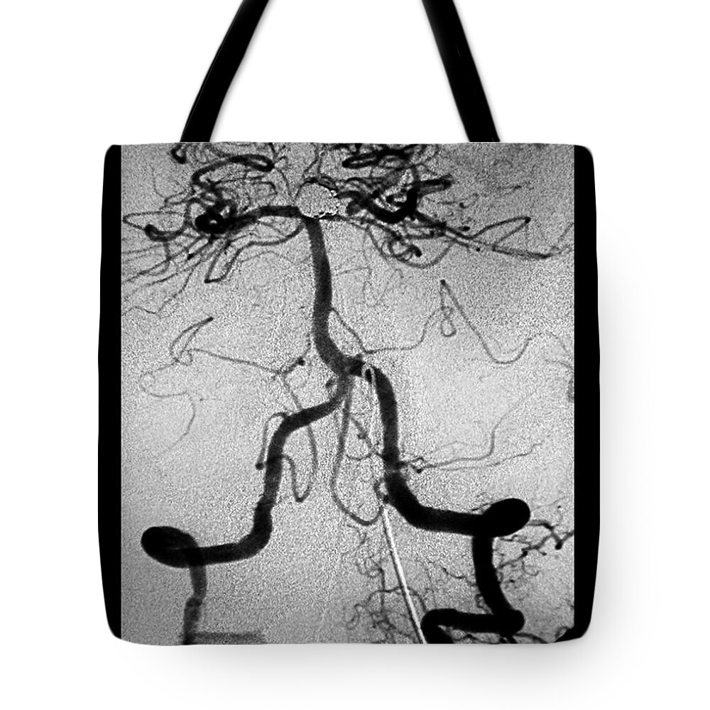 Cerebral Tote Bag featuring the photograph Cerebral Angiogram by Medical Body Scans