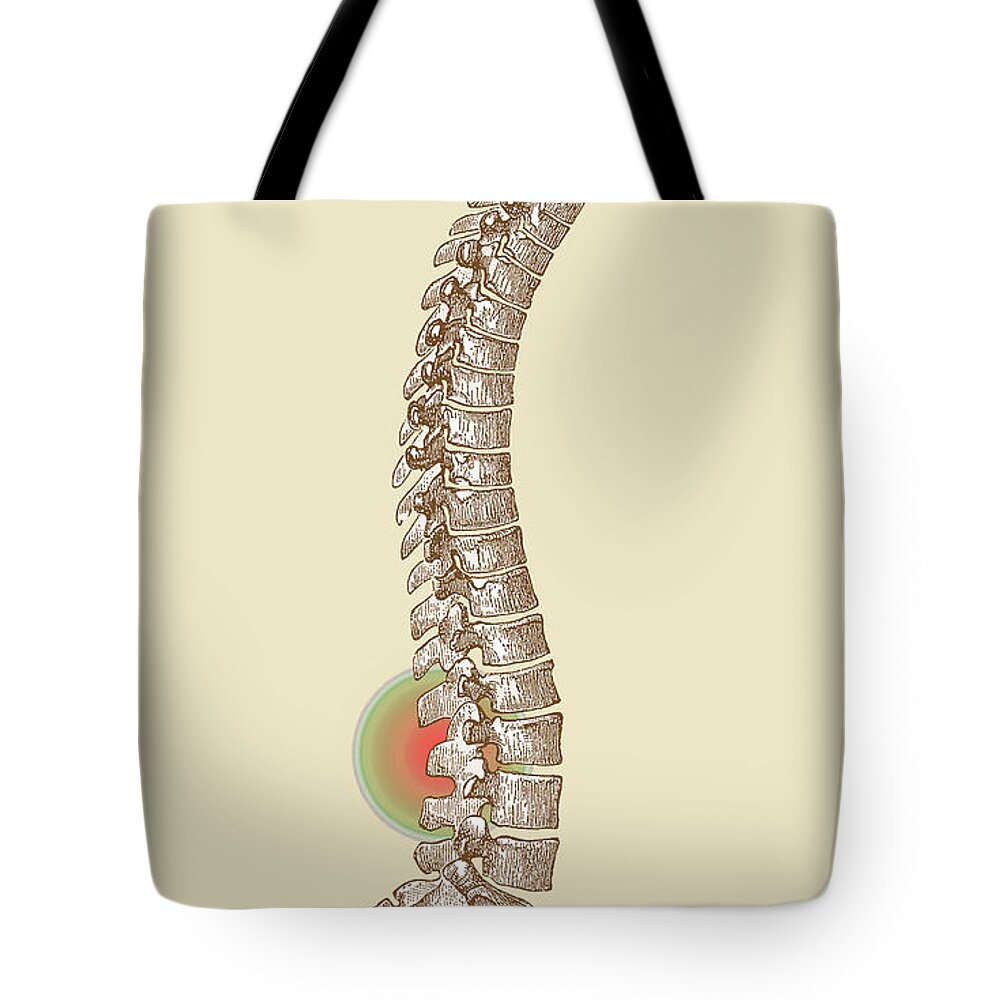 Ache Tote Bag featuring the photograph Lower Back Pain #1 by Science Source