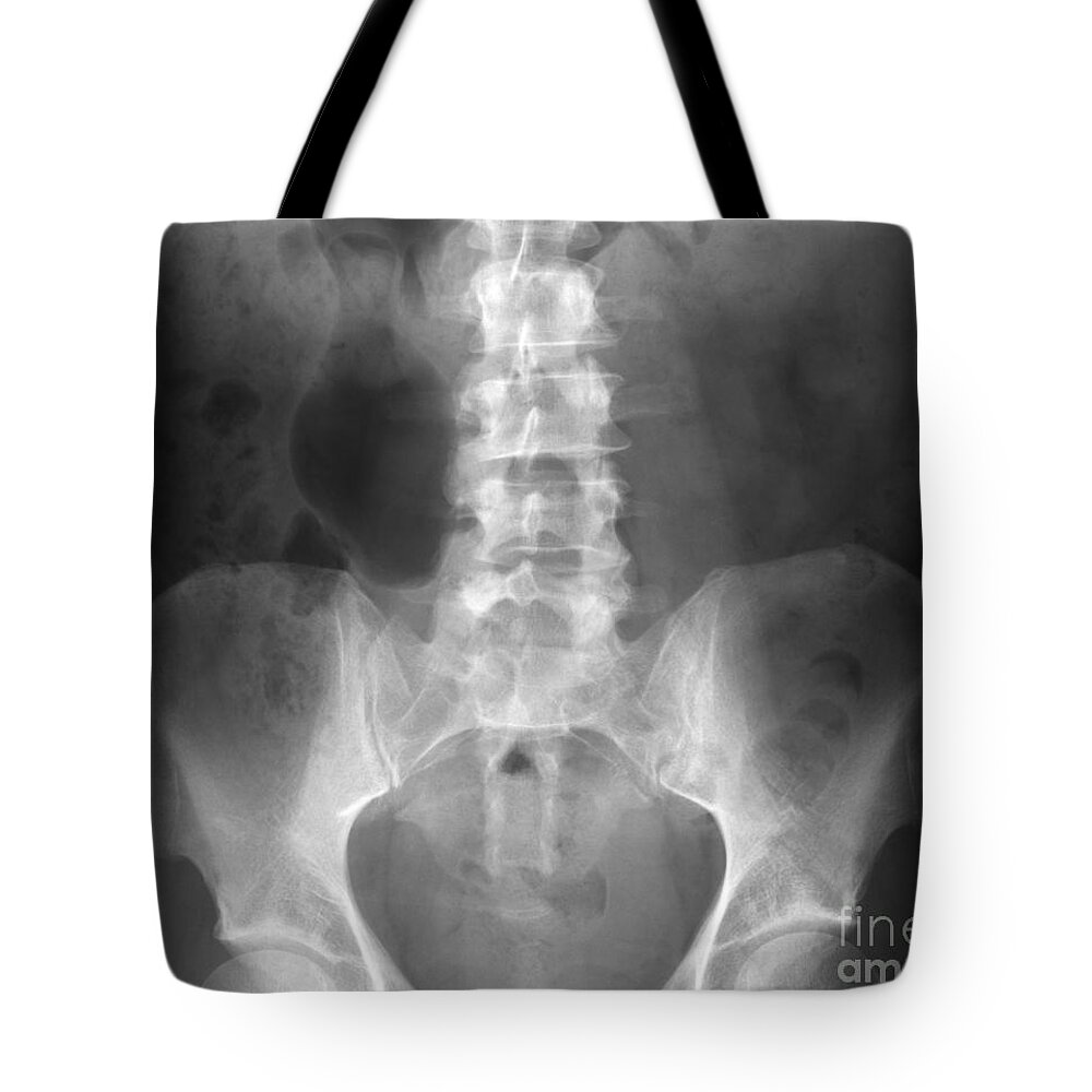 Xray Tote Bag featuring the photograph Lumbar X-ray #1 by Ted Kinsman