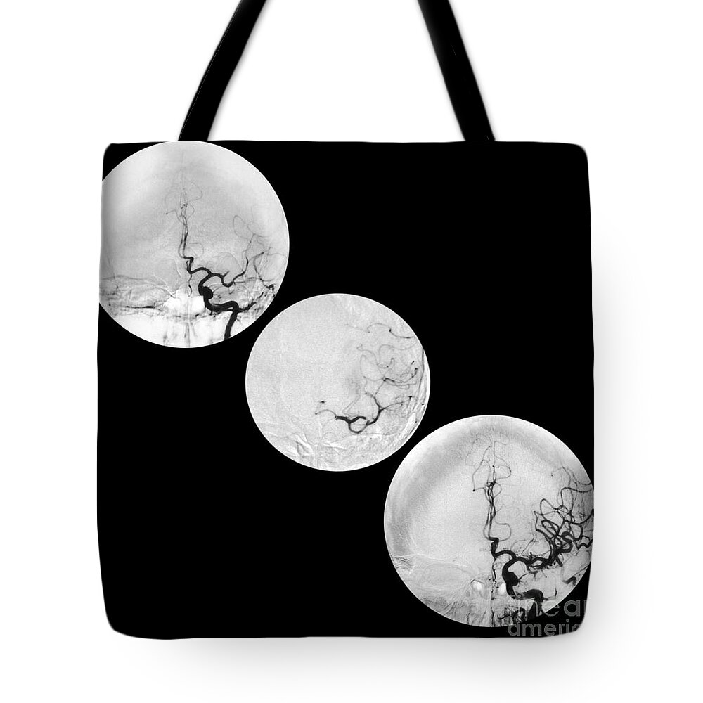 Angiogram Of Stroke Tote Bag featuring the photograph Stroke Treatment by Medical Body Scans