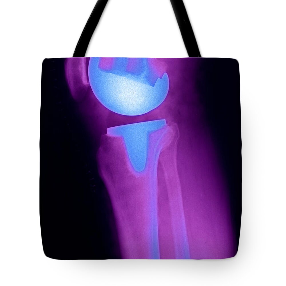 Xray Tote Bag featuring the photograph Knee Replacement X-ray #2 by Ted Kinsman