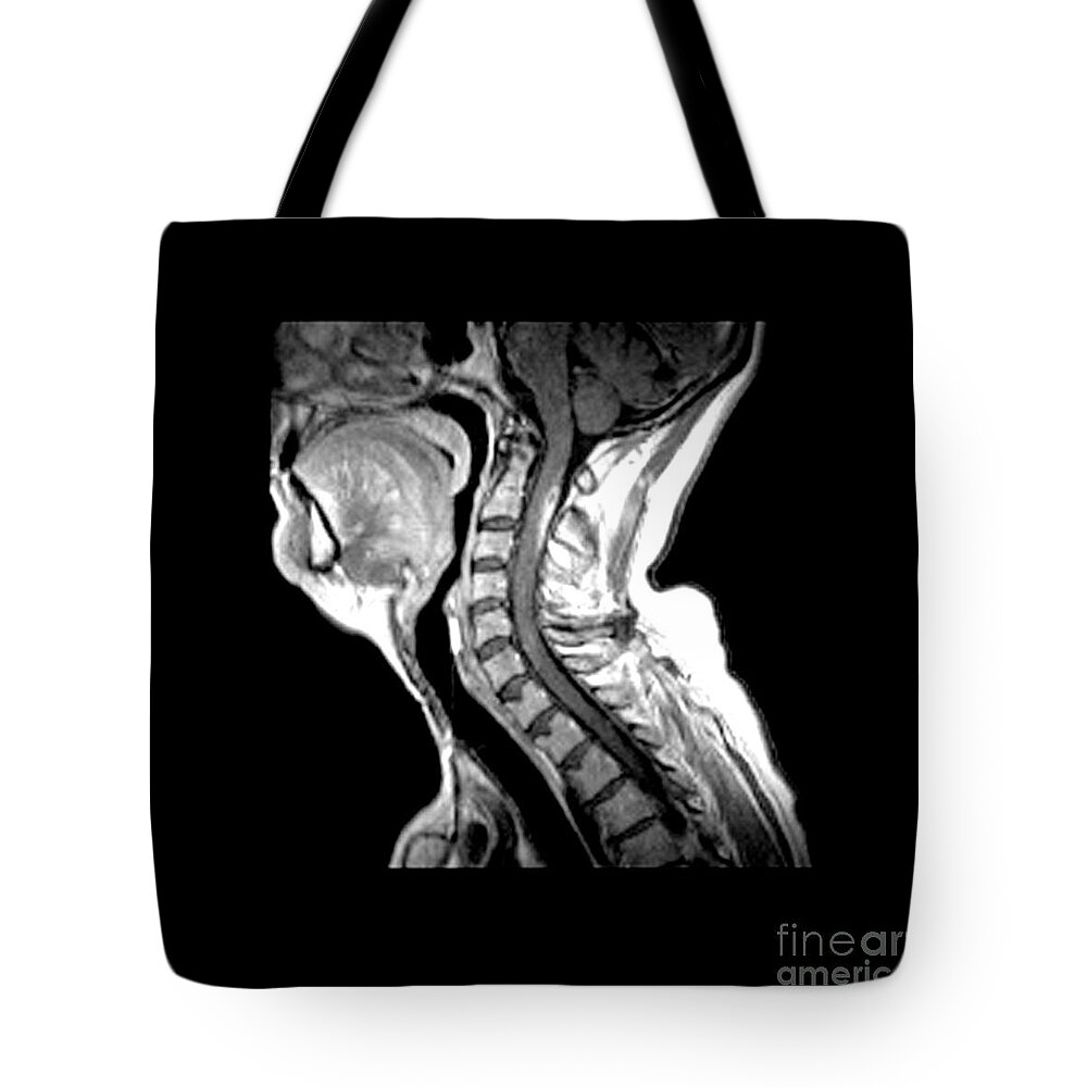 Multiple Sclerosis Tote Bag featuring the photograph Active Demyelination Of Spinal Cord #3 by Medical Body Scans