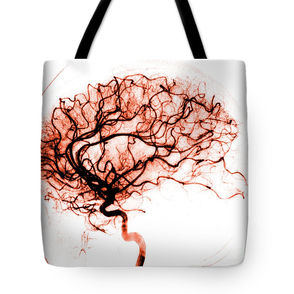 Catheter Cerebral Angiogram Tote Bag featuring the photograph Cerebral Angiogram by Medical Body Scans