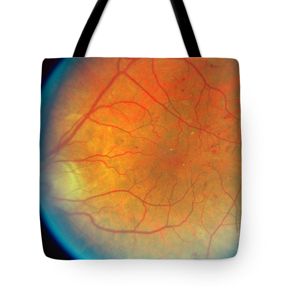 Blood Vessels Tote Bag featuring the photograph Diabetes And Cataracts by Science Source