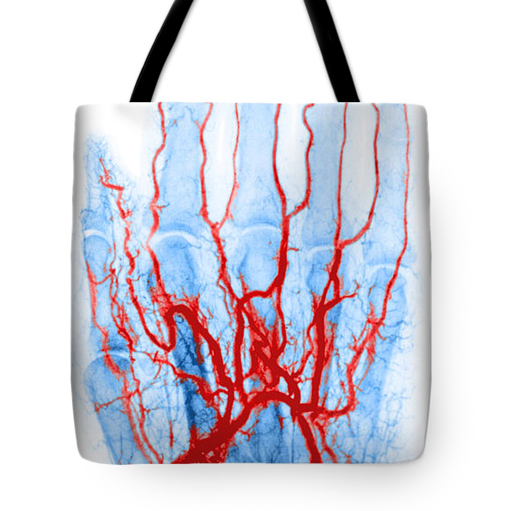 Angiogram Tote Bag featuring the photograph Hand Arteriogram by Science Source