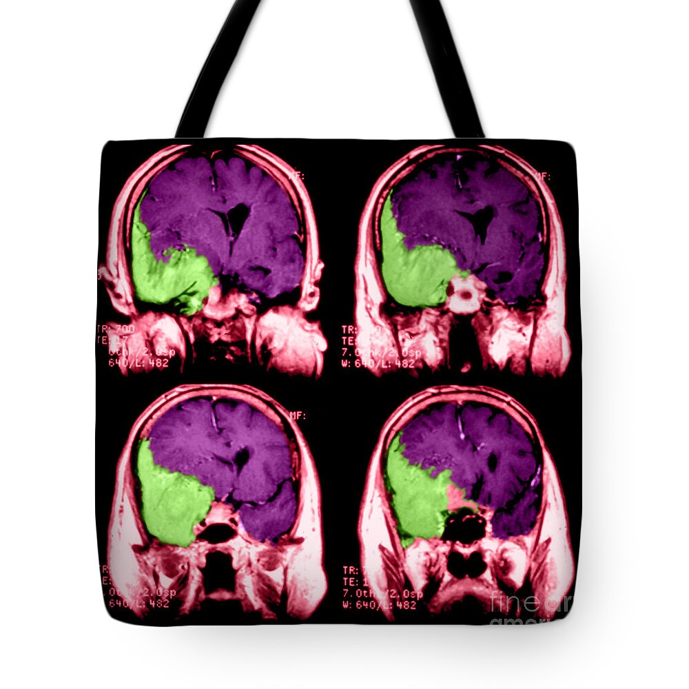 Image Of Invasive Meningioma Tote Bag featuring the photograph Meningioma by Medical Body Scans