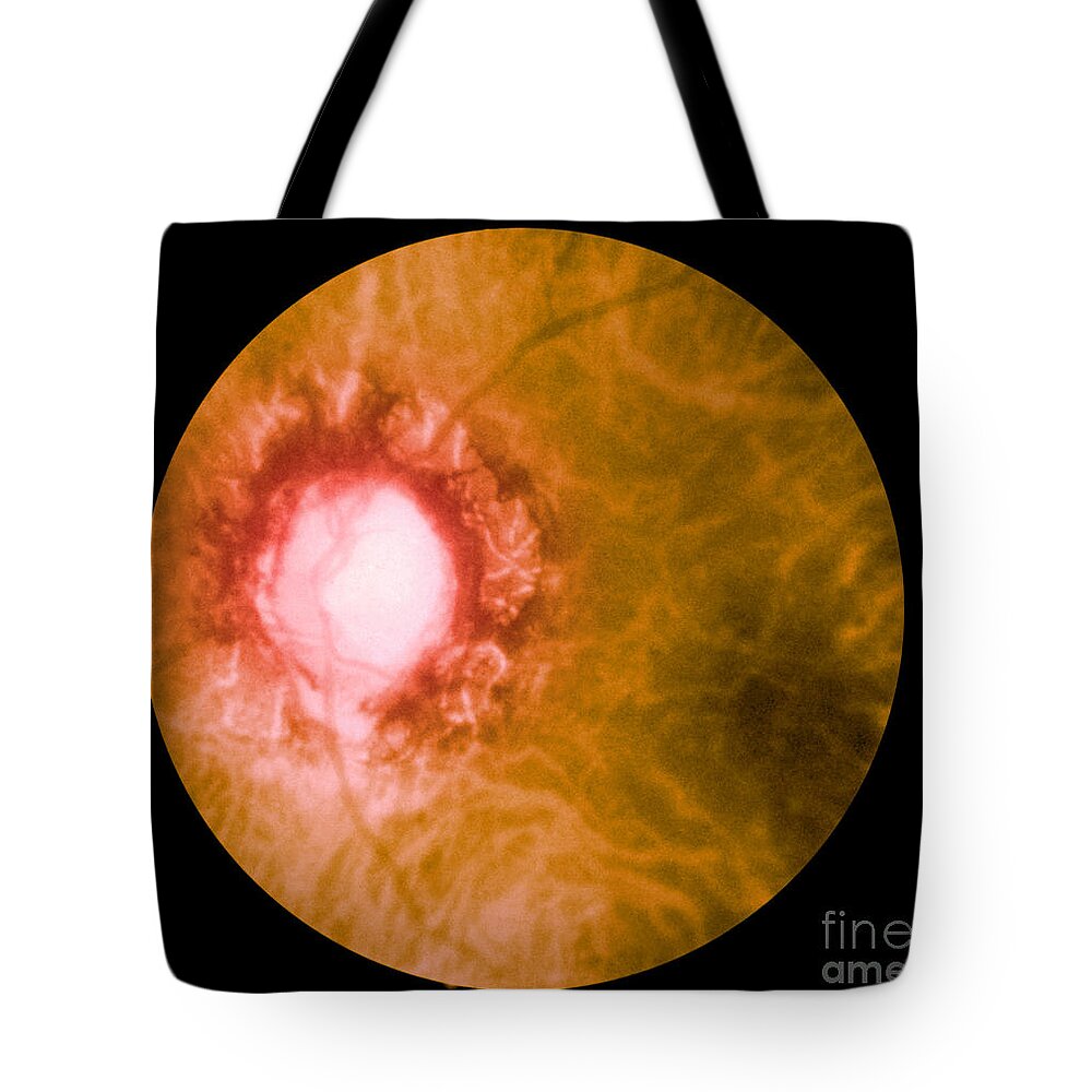 Bacteria Tote Bag featuring the photograph Retina Infected By Syphilis by Science Source