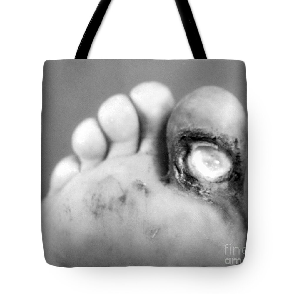 Bacterial Tote Bag featuring the photograph Syphilis Ulcer by Science Source